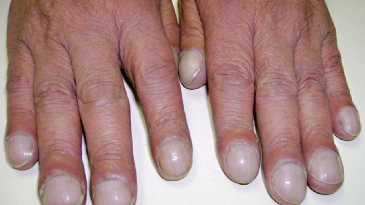 Akciğer kanserinde “çomak parmak” belirtisi