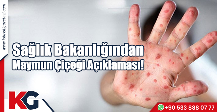 Sağlık Bakanlığından Maymun Çiçeği Açıklaması!