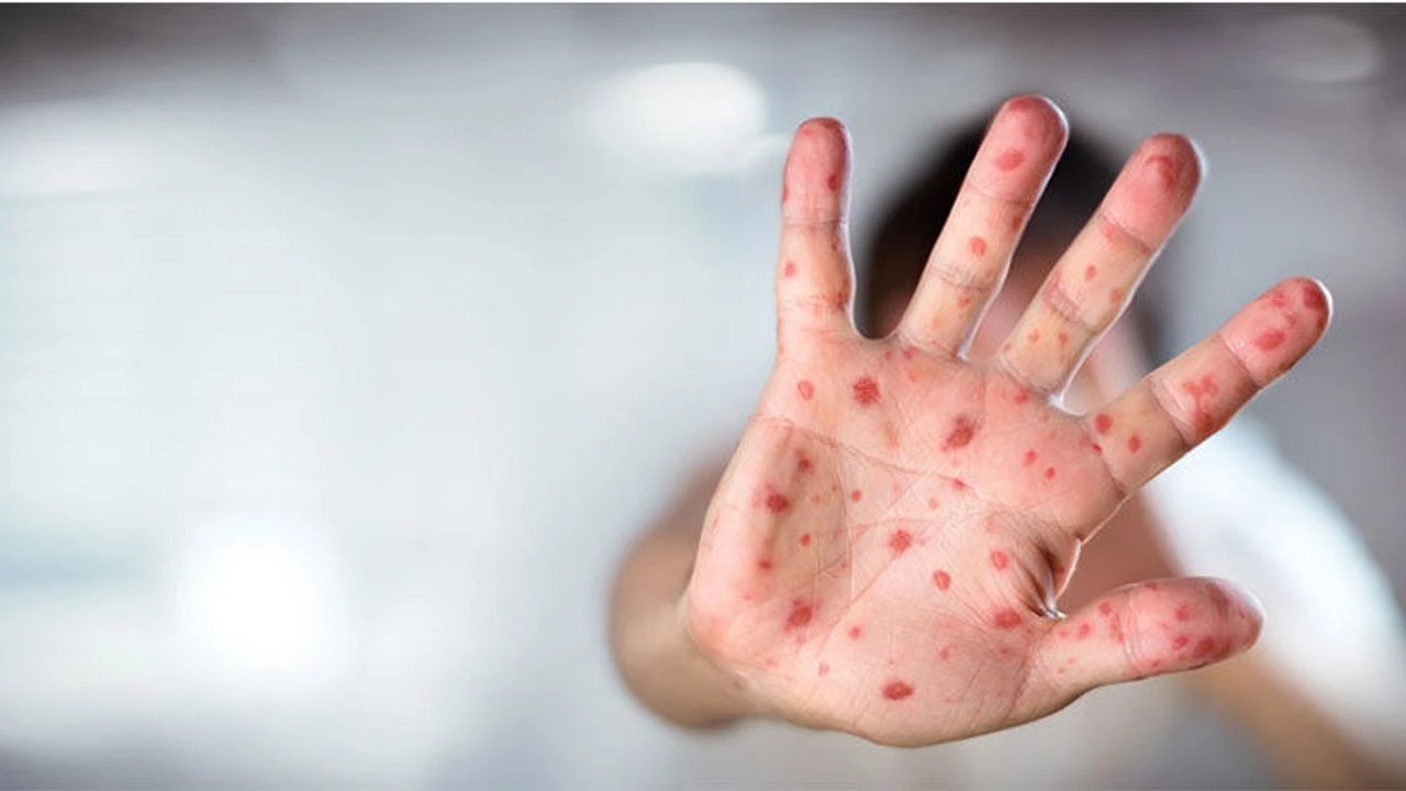 Nijerya'da kızamık salgını…15 çocuk hayatını kaybetti