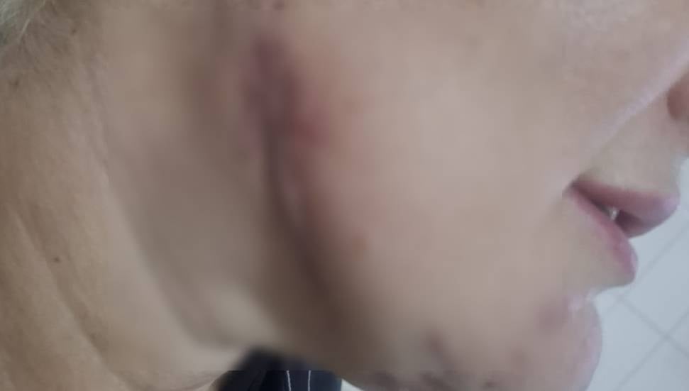 Girne’de özel hastanede skandal iddia: Dolgudan sonra yüzü enfekte oldu