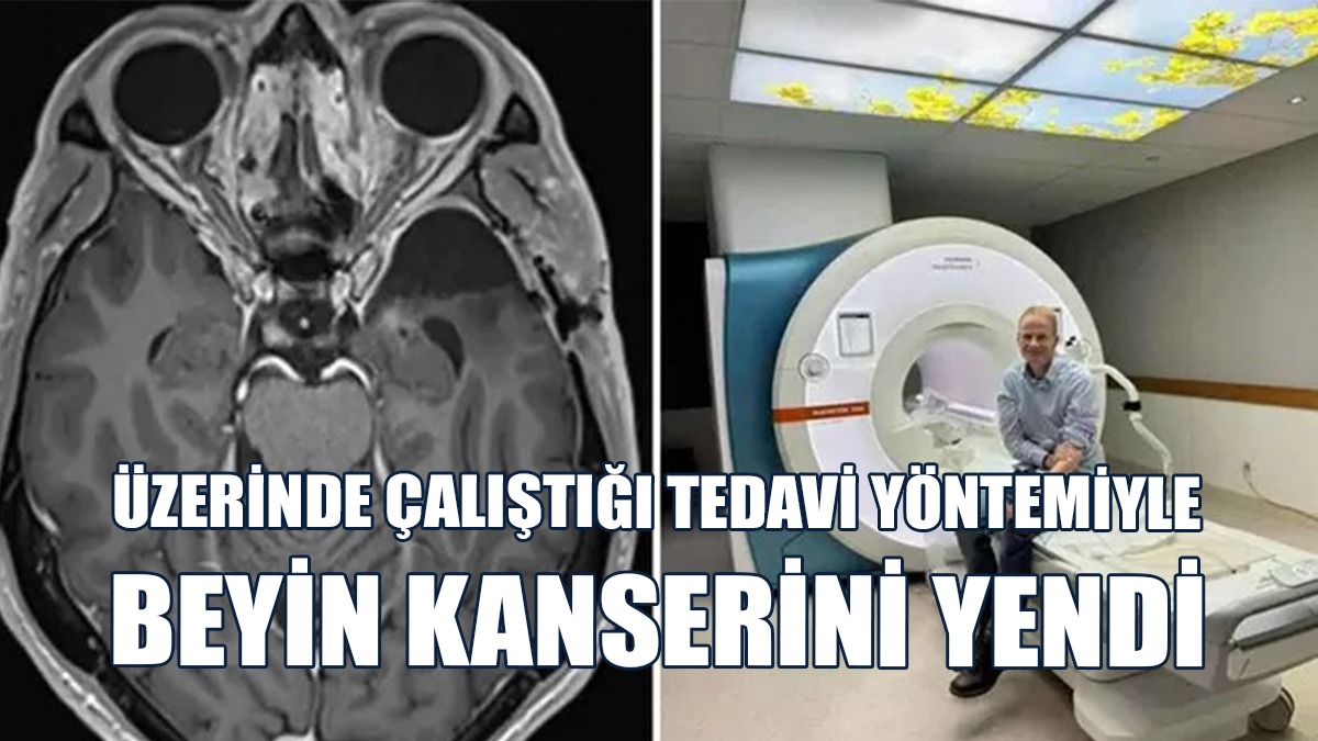 Üzerinde Çalıştığı Tedavi Yöntemiyle Beyin Kanserini Yendi