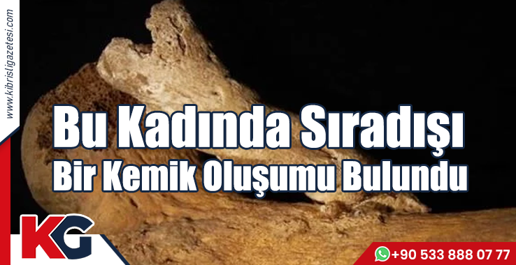 Bu Kadında Sıradışı Bir Kemik Oluşumu Bulundu