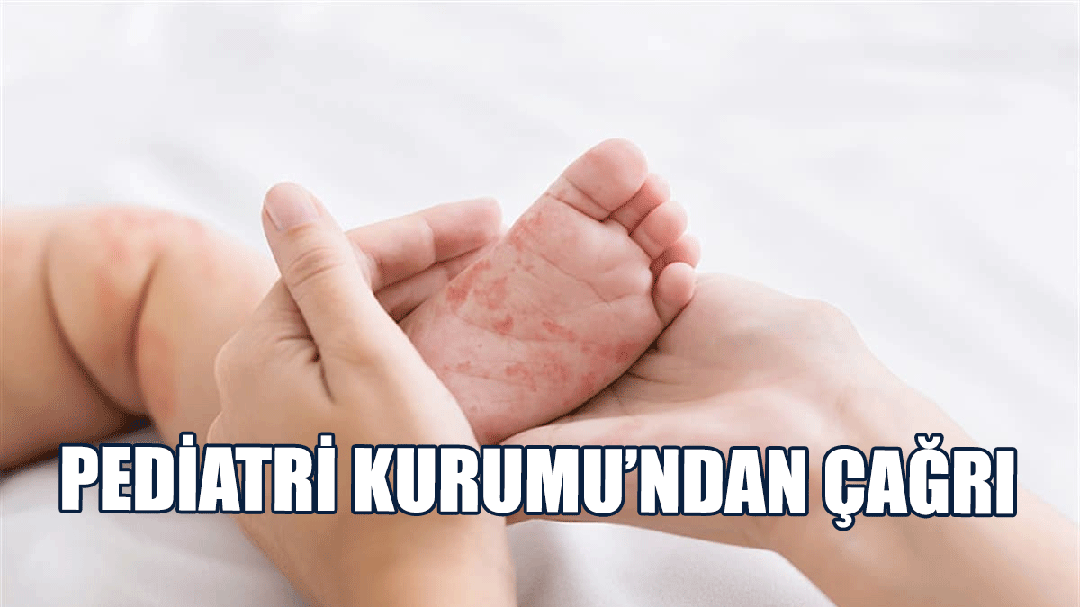 “Kızamık Enfeksiyonu İçin Tedbir Alalım”