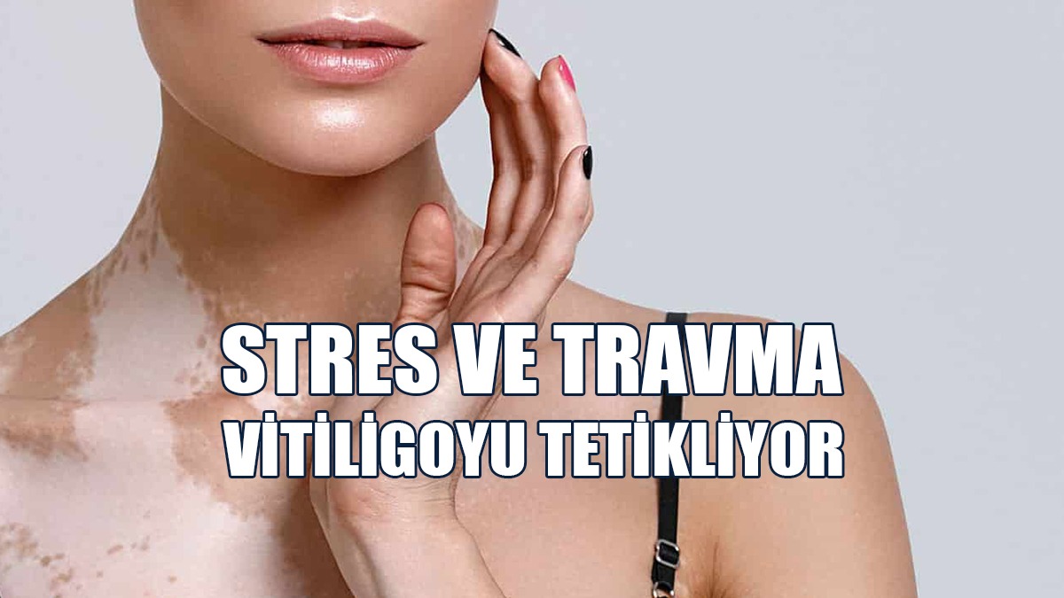 Stres ve Travma Vitiligoyu Tetikliyor