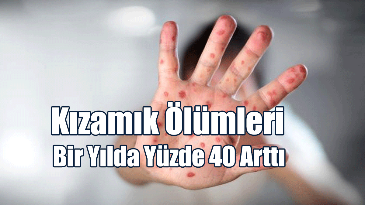Kızamık Ölümleri Bir Yılda Yüzde 40 Arttı