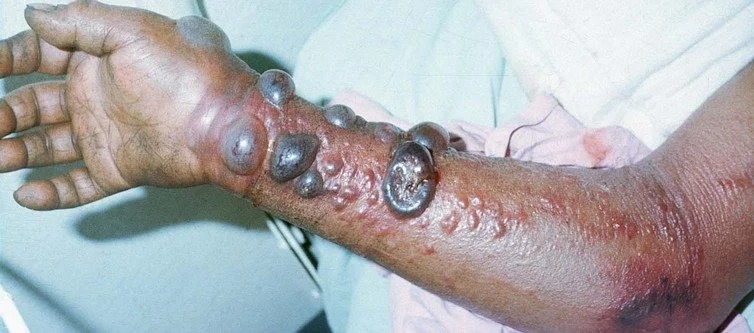 Tabipler Birliği’nden Ebola salgınına karşı ulusal eylem planı çağrısı