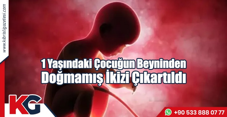 1 Yaşındaki Çocuğun Beyninden Doğmamış İkizi Çıkarıldı