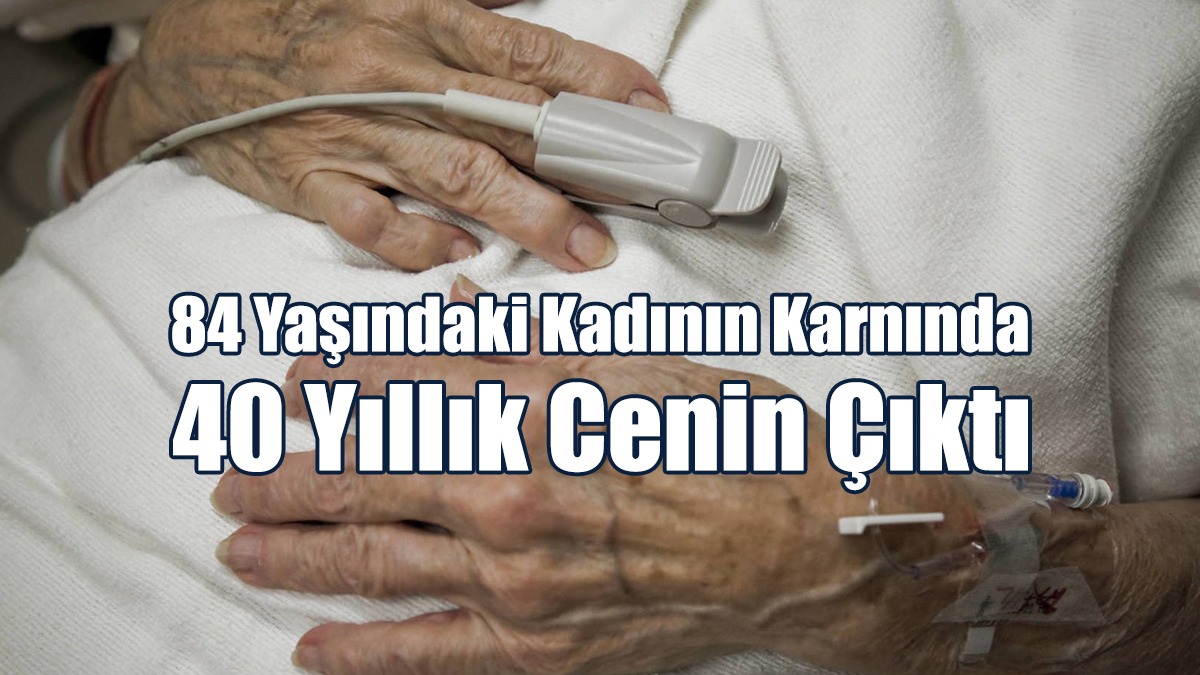 84 Yaşındaki Kadının Karnında 40 Yıllık Cenin Çıktı