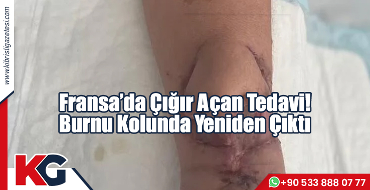 Fransa’da Çığır Açan Tedavi! Burnu Kolunda Yeniden Çıktı