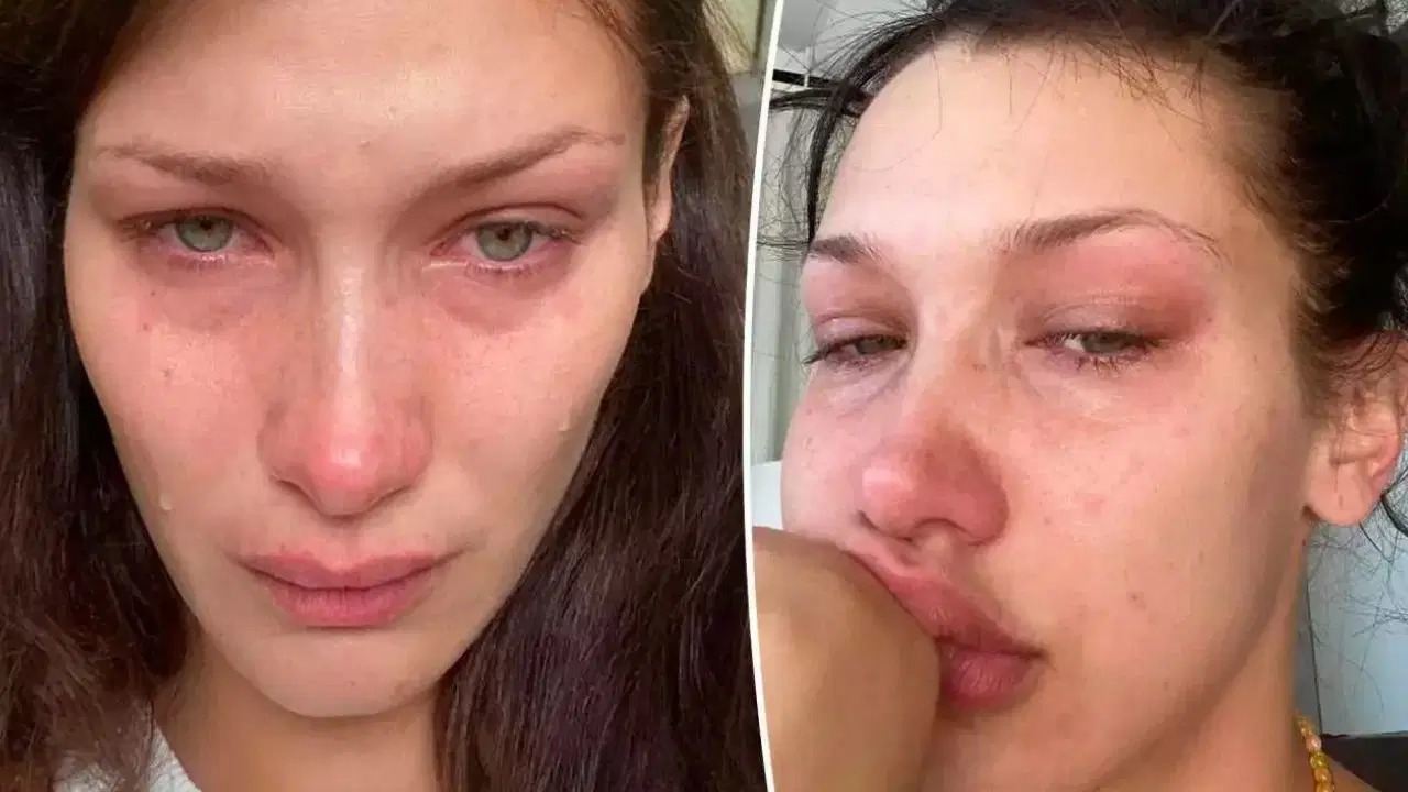Ünlü manken Bella Hadid, Lyme hastalığına yakalandığını duyurdu