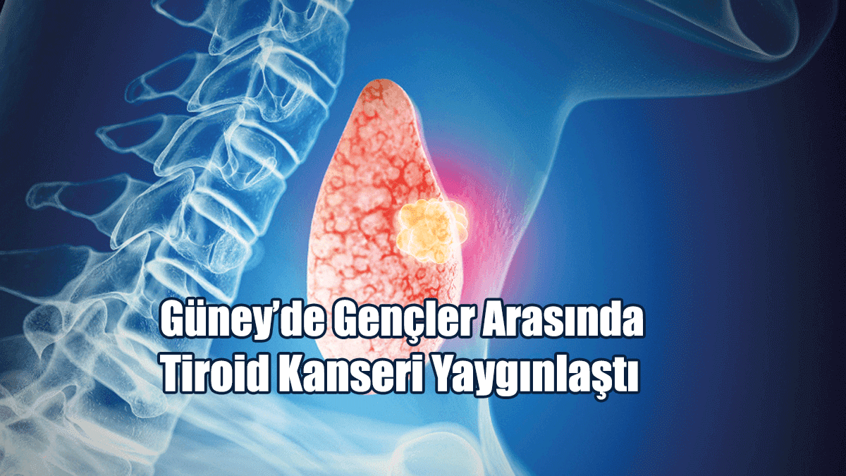 Güney’de Gençler Arasında Tiroid Kanseri Yaygınlaştı