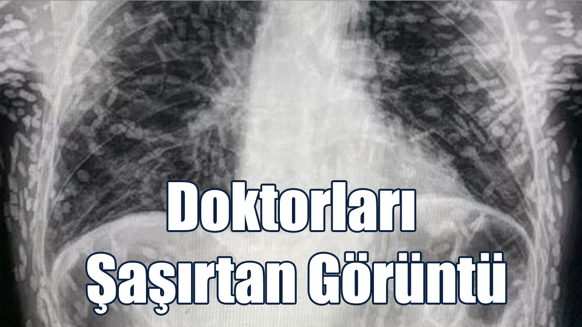 Tenyalar Organlarını Delik Deşik Etti
