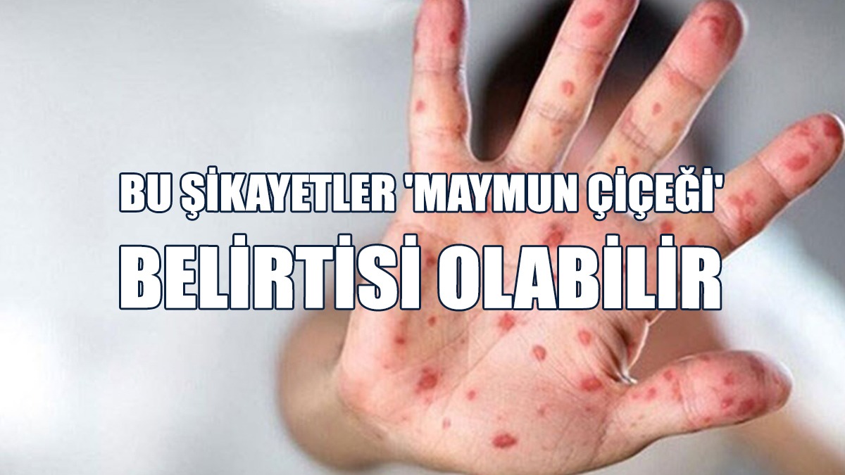 Bu Şikayetler 'Maymun Çiçeği' Belirtisi Olabilir