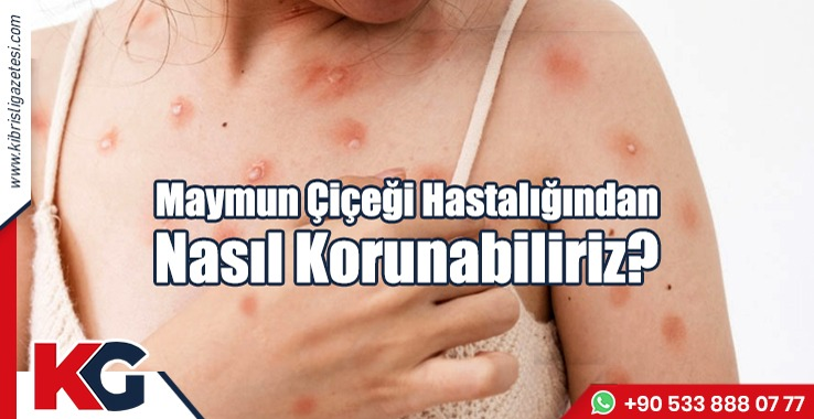 Maymun Çiçeği Hastalığından Nasıl Korunabiliriz?