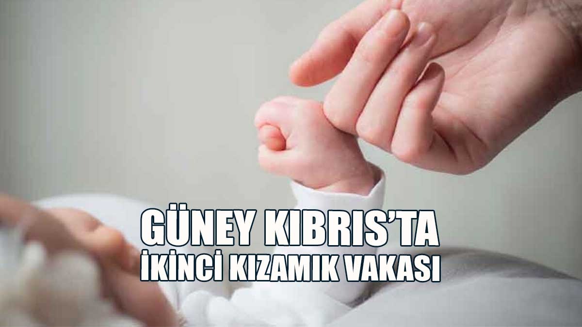 Güney Kıbrıs’ta İkinci Kızamık Vakası
