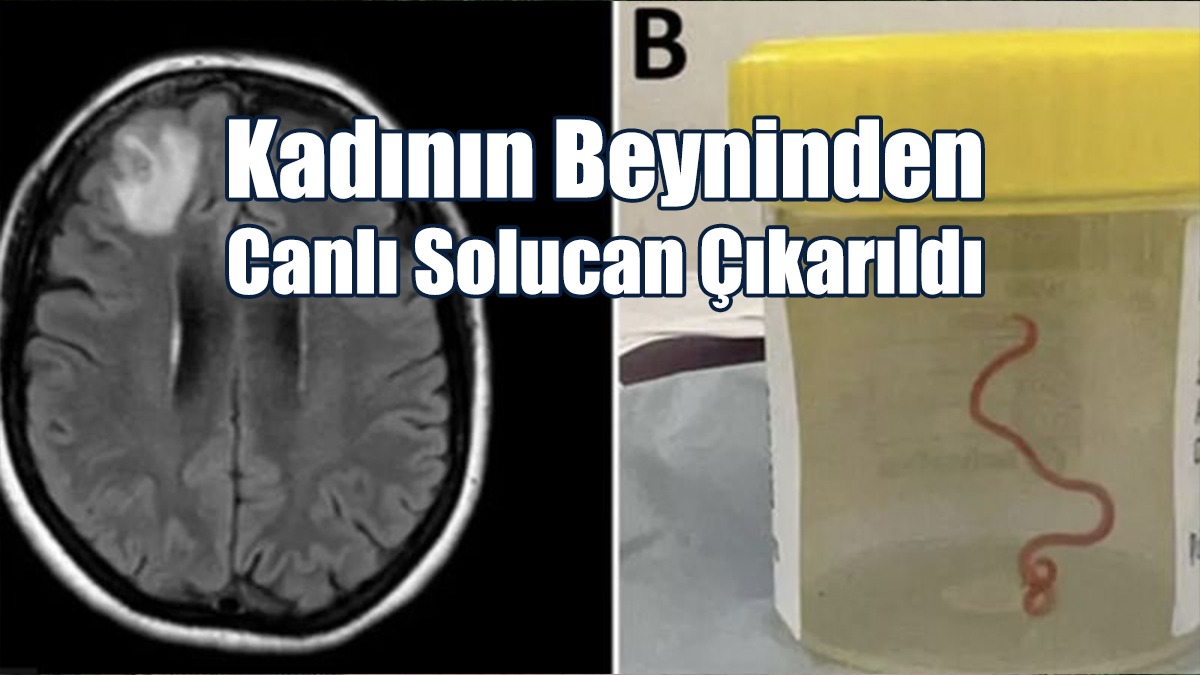 Tıp Literatüründe İlk: Bir Kadının Beyninden Canlı Solucan Çıkarıldı